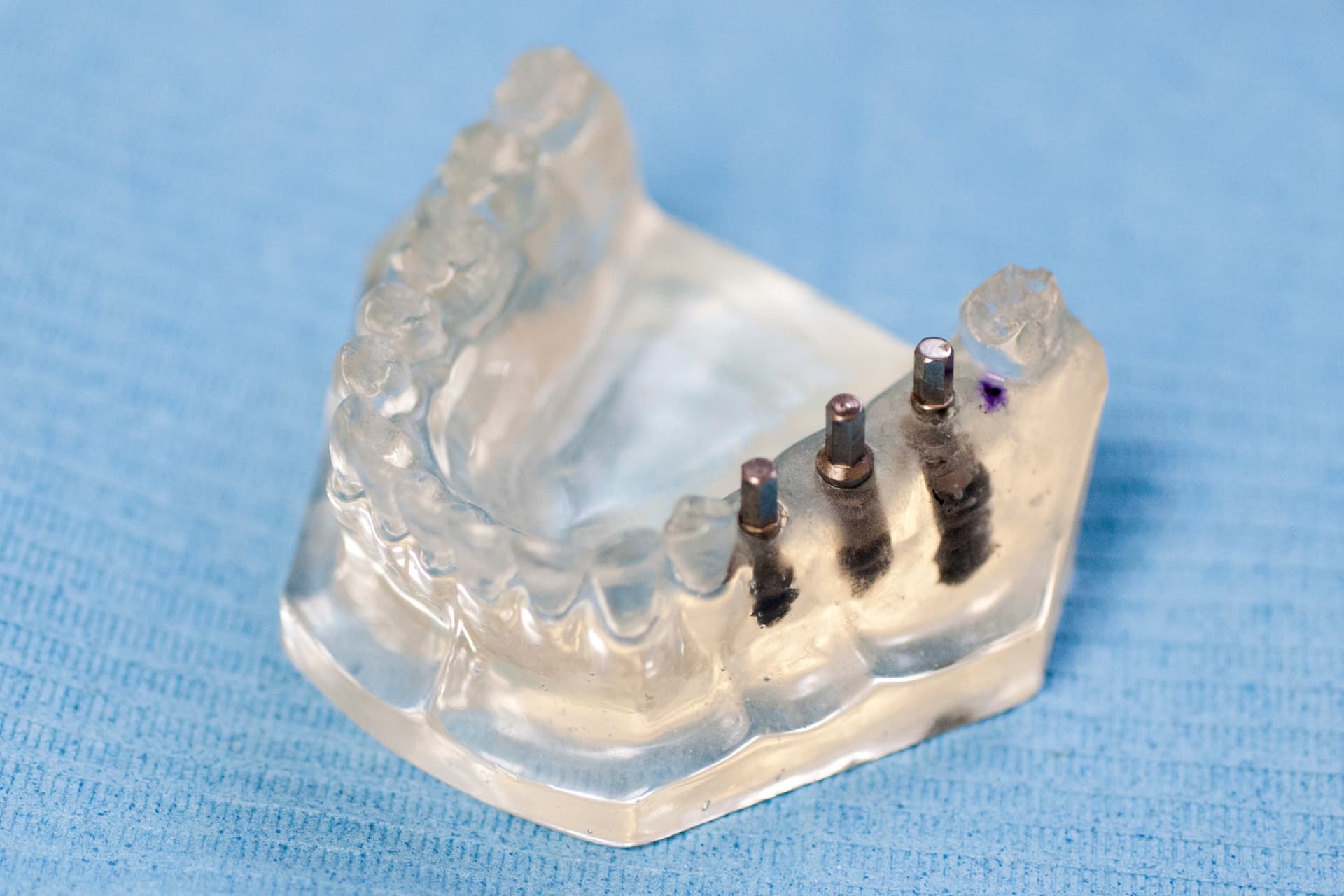 Implantología en Vigo