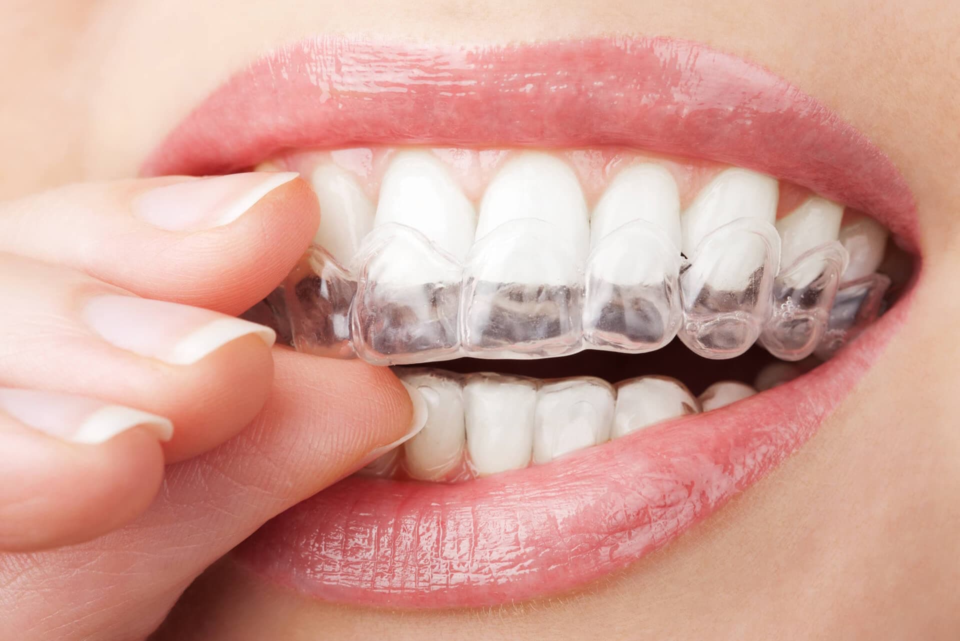 Ortodoncia invisible