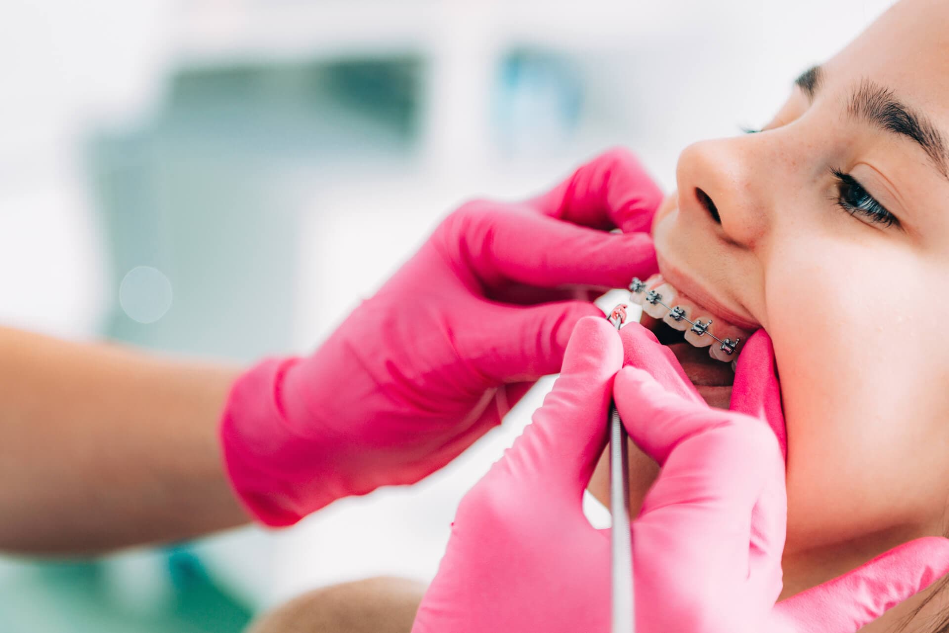  Brackets convencionales